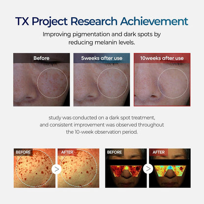 Luhaka®  🧪TX Cream Nano-sized Tranexaminc Acid for Dark Spots & Hyperpigmentation