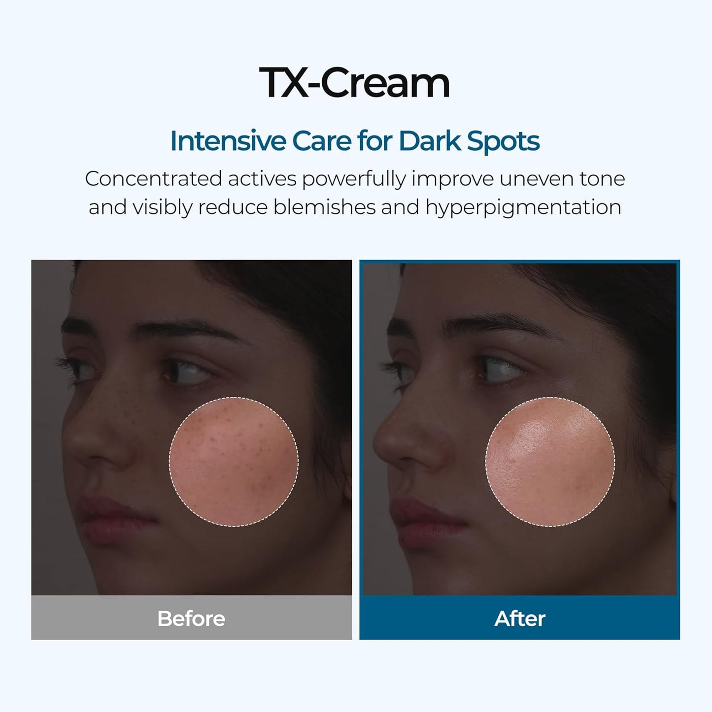 Luhaka®  🧪TX Cream Nano-sized Tranexaminc Acid for Dark Spots & Hyperpigmentation